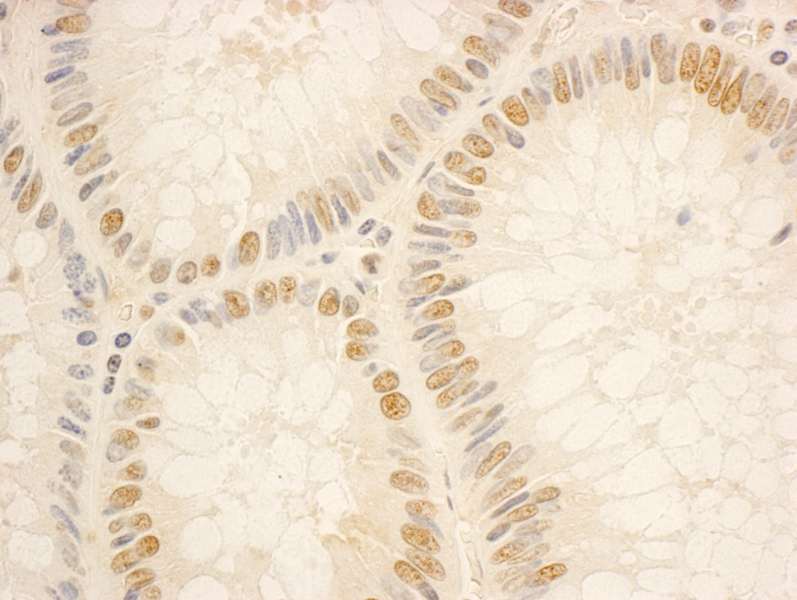 Detection of Human NOP56 by Immunohistochemistry. Sample: FFPE section of human colon carcinoma. Antibody: Affinity purified rabbit anti-NOP56 used at a dilution of 1:1000 (0.2 ug/ml). Detection: DAB.