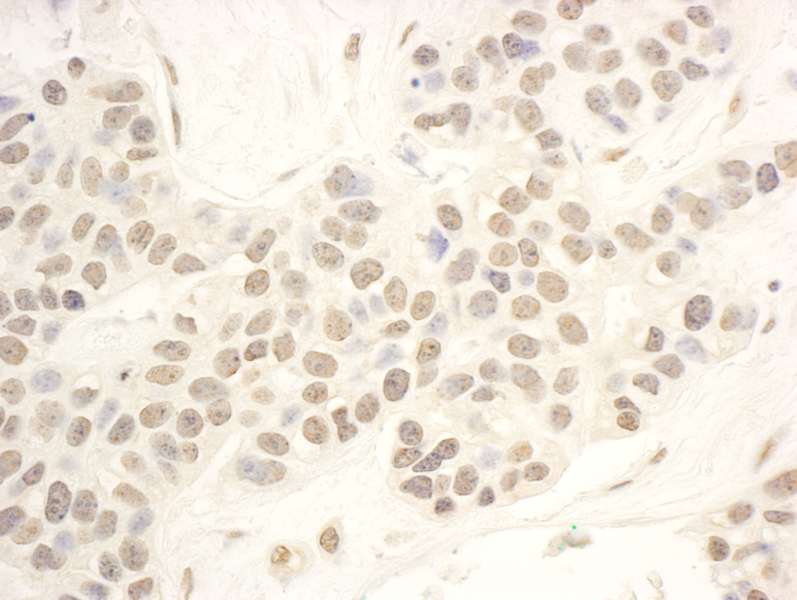 Detection of Human NOP56 by Immunohistochemistry. Sample: FFPE section of human breast carcinoma. Antibody: Affinity purified rabbit anti-NOP56 used at a dilution of 1:200 (1 Detection: DAB.