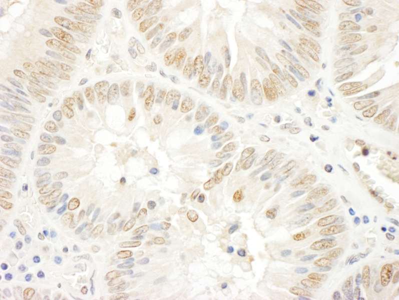 Detection of Human NOPP140 by Immunohistochemistry. Sample: FFPE section of human colon carcinoma. Antibody: Affinity purified rabbit anti-NOPP140 used at a dilution of 1:1000 (1 ug/ml). Detection: DAB.