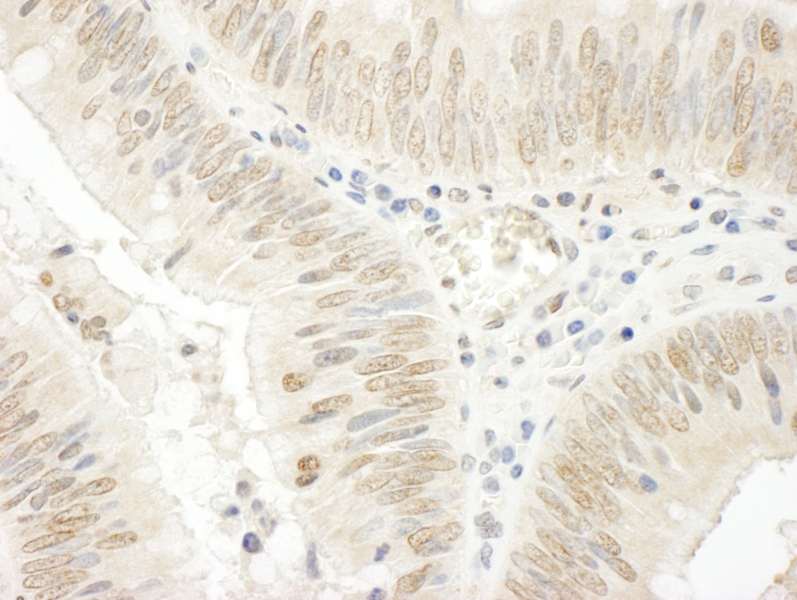 Detection of Human NOPP140 by Immunohistochemistry. Sample: FFPE section of human colon carcinoma. Antibody: Affinity purified rabbit anti-NOPP140 used at a dilution of 1:250.