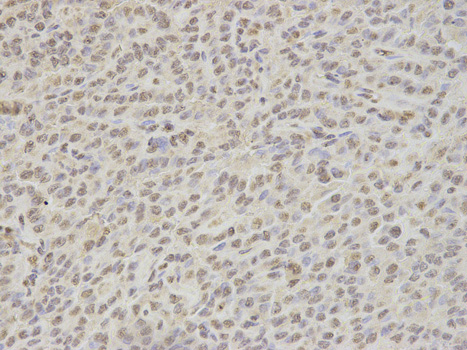 Immunohistochemistry of paraffin-embedded human thyroid cancer using NONO antibody at dilution of 1:200 (200x lens).