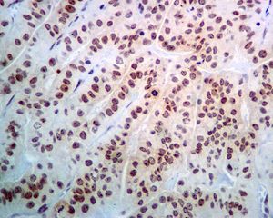 IHC of paraffin-embedded human papillary adenocarcinoma tissue using anti-NOP10 / NOLA3 antibody.