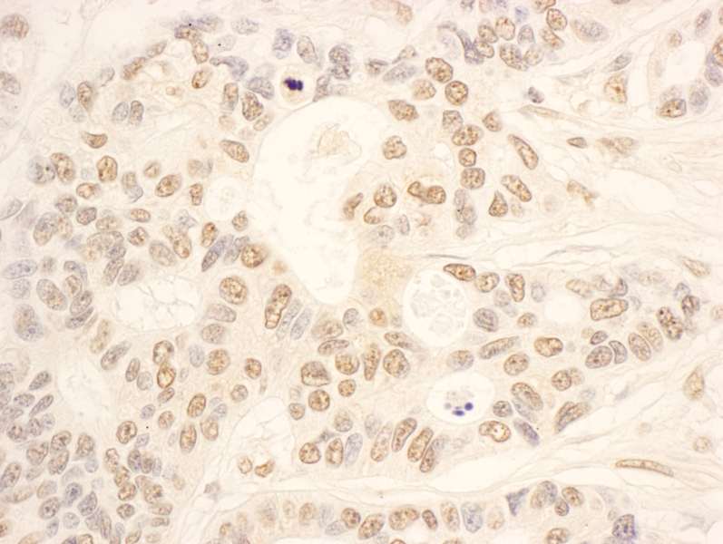 Detection of Human NOP58 by Immunohistochemistry. Sample: FFPE section of human ovarian carcinoma. Antibody: Affinity purified rabbit anti-NOP58 used at a dilution of 1:1000 (0.2 ug/ml). Detection: DAB.