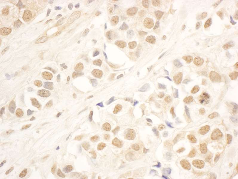 Detection of Human NOP58 by Immunohistochemistry. Sample: FFPE section of human breast carcinoma. Antibody: Affinity purified rabbit anti-NOP58 used at a dilution of 1:5000 (0.2 ug/ml). Detection: DAB.