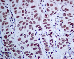 IHC of paraffin embedded human breast carcinoma tissue using anti-MED4 antibody.