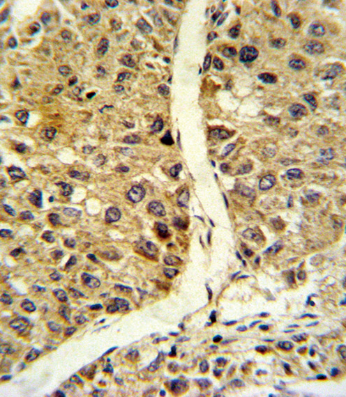 Formalin-fixed and paraffin-embedded human hepatocarcinoma reacted with NOS3 Antibody , which was peroxidase-conjugated to the secondary antibody, followed by DAB staining. This data demonstrates the use of this antibody for immunohistochemistry; clinical relevance has not been evaluated.
