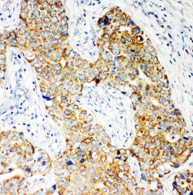 NOX5 antibody. IHC(P): Human Breast Cancer Tissue.