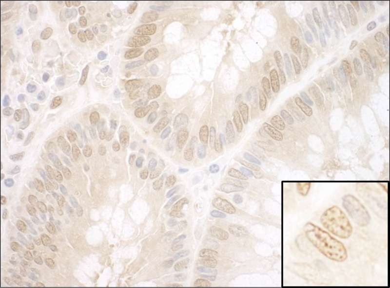 Detection of Human NPAT by Immunohistochemistry. Sample: FFPE section of human colon carcinoma. Antibody: Affinity purified rabbit anti-NPAT used at a dilution of 1:1000 (1 Detection: DAB.