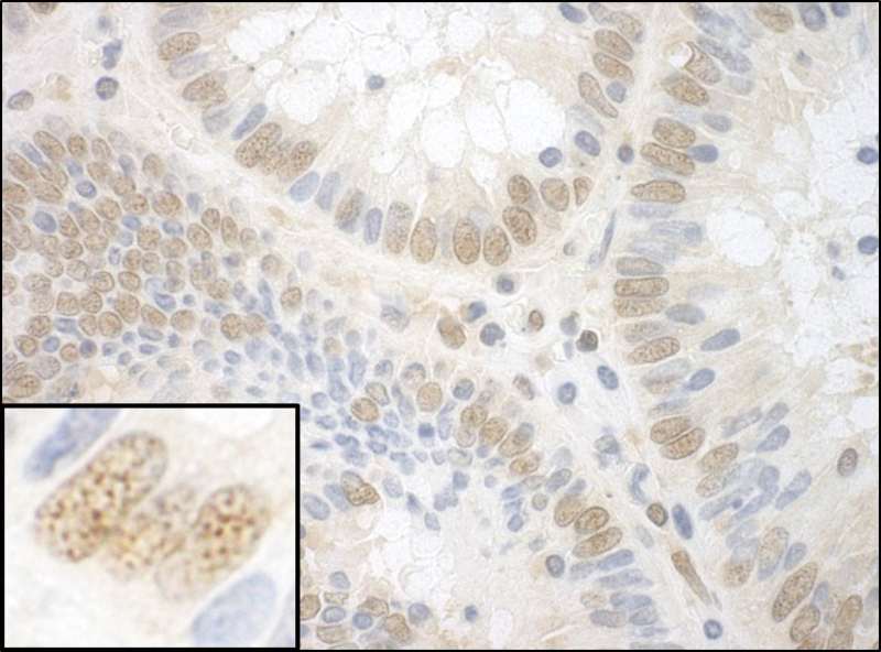 Detection of Human NPAT by Immunohistochemistry. Sample: FFPE section of human colon carcinoma. Antibody: Affinity purified rabbit anti-NPAT used at a dilution of 1:1000 (1 Detection: DAB.