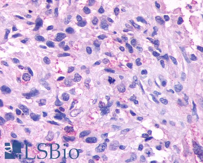 Anti-NPBWR1 / GPR7 antibody IHC of human Brain, Glioblastoma. Immunohistochemistry of formalin-fixed, paraffin-embedded tissue after heat-induced antigen retrieval.