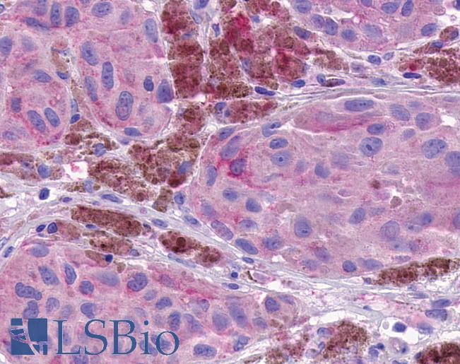 Anti-NPBWR1 / GPR7 antibody IHC of human Skin, Melanoma. Immunohistochemistry of formalin-fixed, paraffin-embedded tissue after heat-induced antigen retrieval.