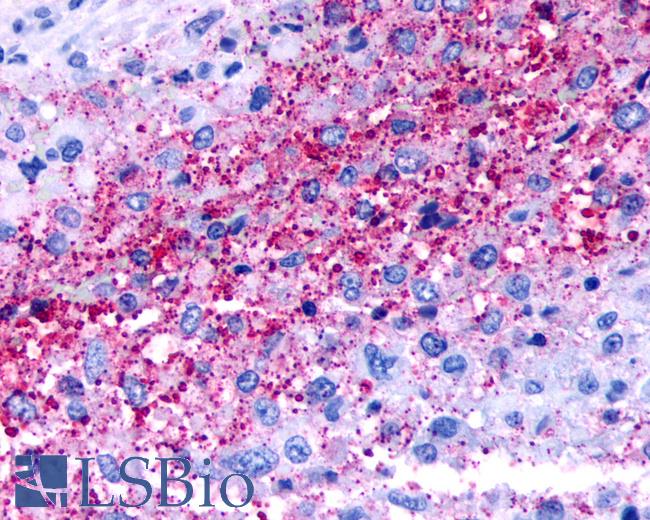 Anti-NPBWR1 / GPR7 antibody IHC of human Brain, Glioblastoma. Immunohistochemistry of formalin-fixed, paraffin-embedded tissue after heat-induced antigen retrieval.