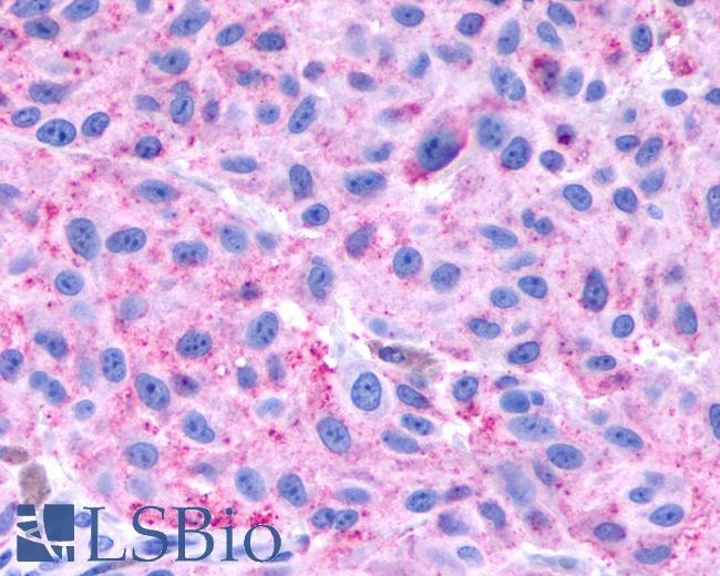 Anti-NPBWR1 / GPR7 antibody IHC of human Skin, Melanoma. Immunohistochemistry of formalin-fixed, paraffin-embedded tissue after heat-induced antigen retrieval.