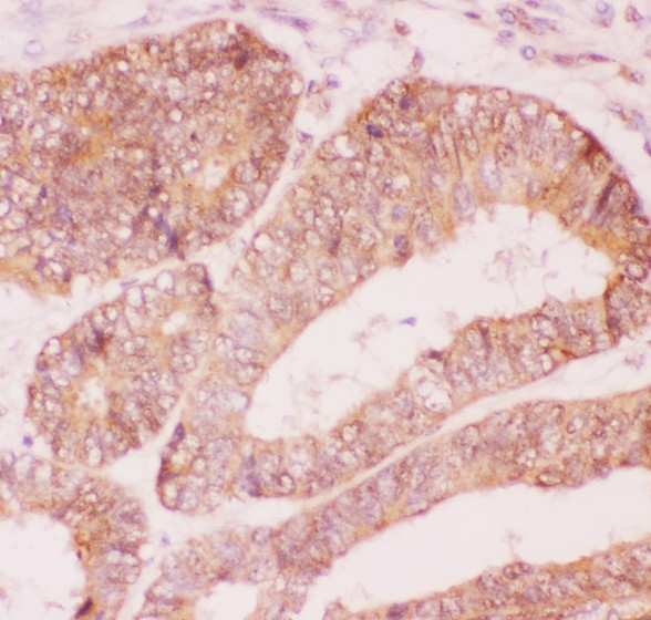 Nephrin antibody IHC-paraffin: Human Intestinal Cancer Tissue.