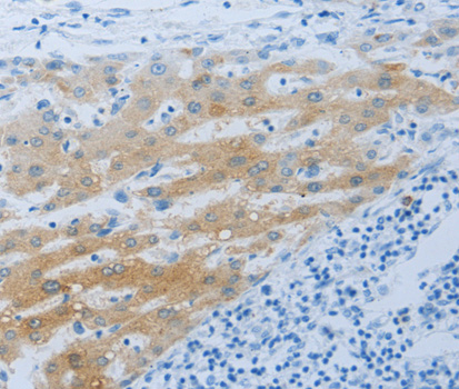 Immunohistochemistry of paraffin-embedded Human liver cancer tissue using NPHS1 antibody.