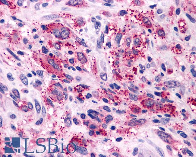 Anti-NPY1R antibody IHC of human Brain, Glioblastoma. Immunohistochemistry of formalin-fixed, paraffin-embedded tissue after heat-induced antigen retrieval.