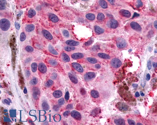 Anti-NPY1R antibody IHC of human Skin, Melanoma. Immunohistochemistry of formalin-fixed, paraffin-embedded tissue after heat-induced antigen retrieval.