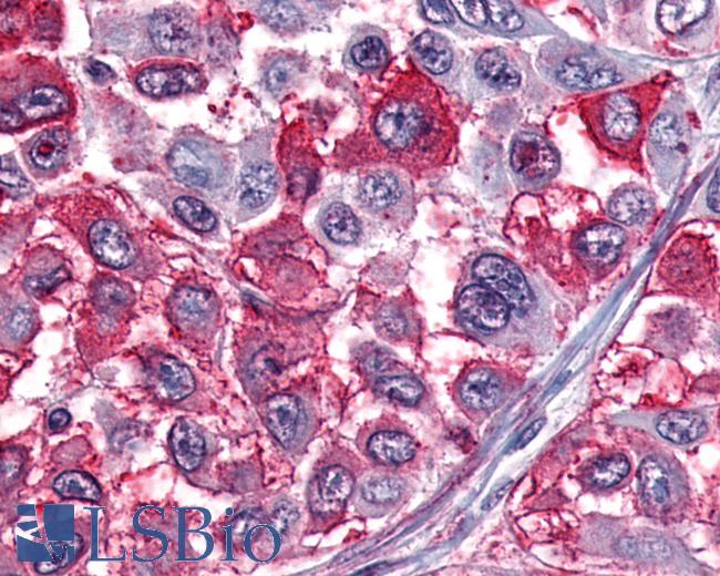 Anti-NPY1R antibody IHC of human Skin, Melanoma. Immunohistochemistry of formalin-fixed, paraffin-embedded tissue after heat-induced antigen retrieval.