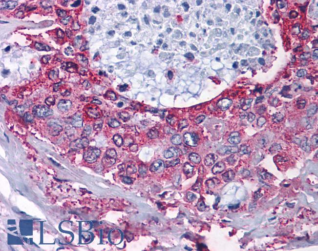 Anti-NPY2R antibody IHC of human Pancreas, Carcinoma. Immunohistochemistry of formalin-fixed, paraffin-embedded tissue after heat-induced antigen retrieval.