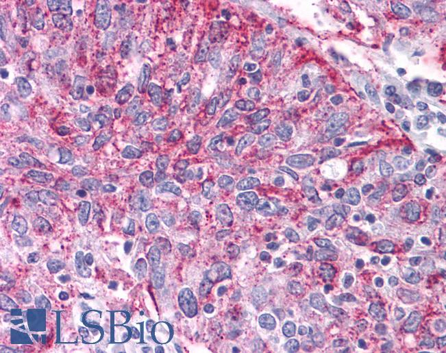 Anti-NPY2R antibody IHC of human Ovary, Carcinoma. Immunohistochemistry of formalin-fixed, paraffin-embedded tissue after heat-induced antigen retrieval.