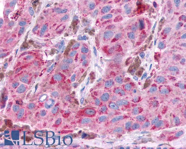 Anti-NPY4R / PPYR1 antibody IHC of human Skin, Melanoma. Immunohistochemistry of formalin-fixed, paraffin-embedded tissue after heat-induced antigen retrieval.