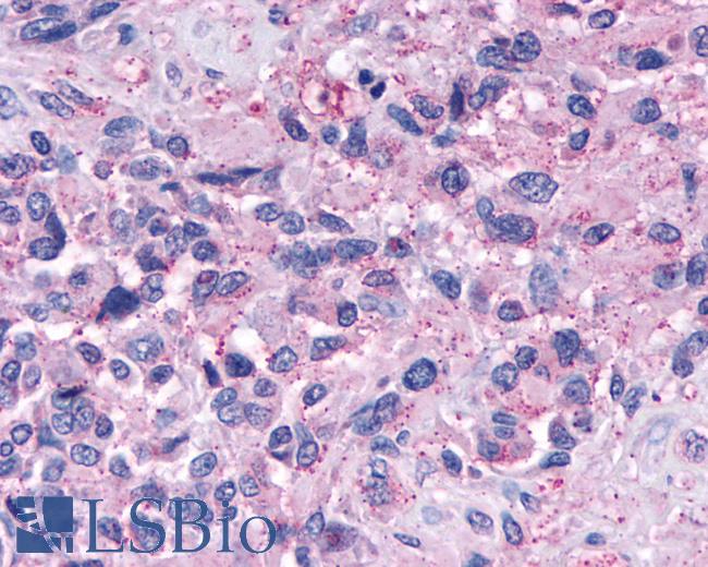 Anti-NPY4R / PPYR1 antibody IHC of human Brain, Glioblastoma. Immunohistochemistry of formalin-fixed, paraffin-embedded tissue after heat-induced antigen retrieval.