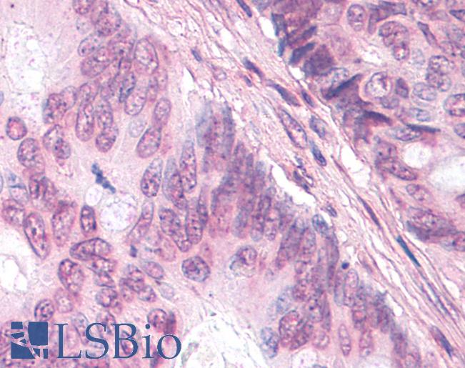 Anti-NR0B1 / DAX1 antibody IHC of human Colon, Carcinoma. Immunohistochemistry of formalin-fixed, paraffin-embedded tissue after heat-induced antigen retrieval.