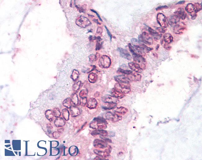 Anti-NR0B1 / DAX1 antibody IHC of human Lung, Non-Small Cell Carcinoma. Immunohistochemistry of formalin-fixed, paraffin-embedded tissue after heat-induced antigen retrieval.