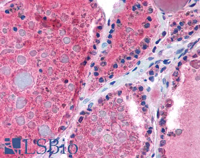 Anti-THRB antibody IHC of human thyroid. Immunohistochemistry of formalin-fixed, paraffin-embedded tissue after heat-induced antigen retrieval. Antibody LS-B1005 concentration 5 ug/ml.