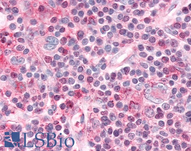 Anti-NR1D1 antibody IHC of human Lymph Node, Hodgkins Lymphoma. Immunohistochemistry of formalin-fixed, paraffin-embedded tissue after heat-induced antigen retrieval.