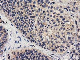 IHC of paraffin-embedded Carcinoma of Human bladder tissue using anti-MEF2C mouse monoclonal antibody.