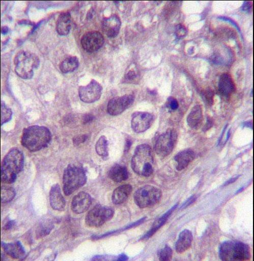 NR3C1 Antibody immunohistochemistry of formalin-fixed and paraffin-embedded human breast carcinoma followed by peroxidase-conjugated secondary antibody and DAB staining.