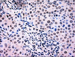 IHC of paraffin-embedded Adenocarcinoma of breast tissue using anti-NRBP1 mouse monoclonal antibody. (Dilution 1:50).