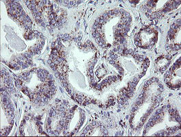 IHC of paraffin-embedded Carcinoma of Human prostate tissue using anti-NRIP3 mouse monoclonal antibody. (Heat-induced epitope retrieval by 10mM citric buffer, pH6.0, 100C for 10min).