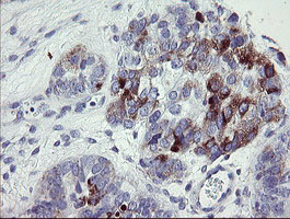 IHC of paraffin-embedded Adenocarcinoma of Human ovary tissue using anti-NRIP3 mouse monoclonal antibody. (Heat-induced epitope retrieval by 10mM citric buffer, pH6.0, 100C for 10min).