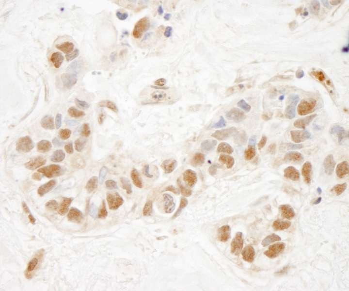 Detection of Human NSD1 by Immunohistochemistry. Sample: FFPE section of human breast carcinoma. Antibody: Affinity purified rabbit anti-NSD1 used at a dilution of 1:250.