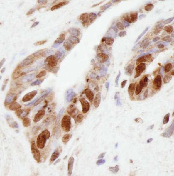 Detection of Human NSD1 by Immunohistochemistry. Sample: FFPE section of human prostate adenocarcinoma. Antibody: Affinity purified rabbit anti-NSD1 used at a dilution of 1:250. Detection: DAB.