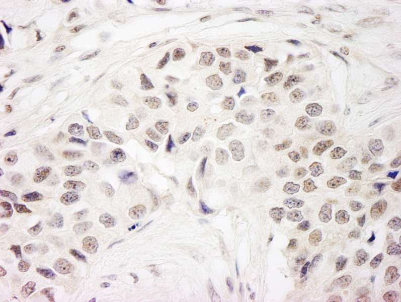 Detection of Human DC8 by Immunohistochemistry. Sample: FFPE section of human breast carcinoma. Antibody: Affinity purified rabbit anti-DC8 used at a dilution of 1:1000 (1 ug/ml). Detection: DAB.