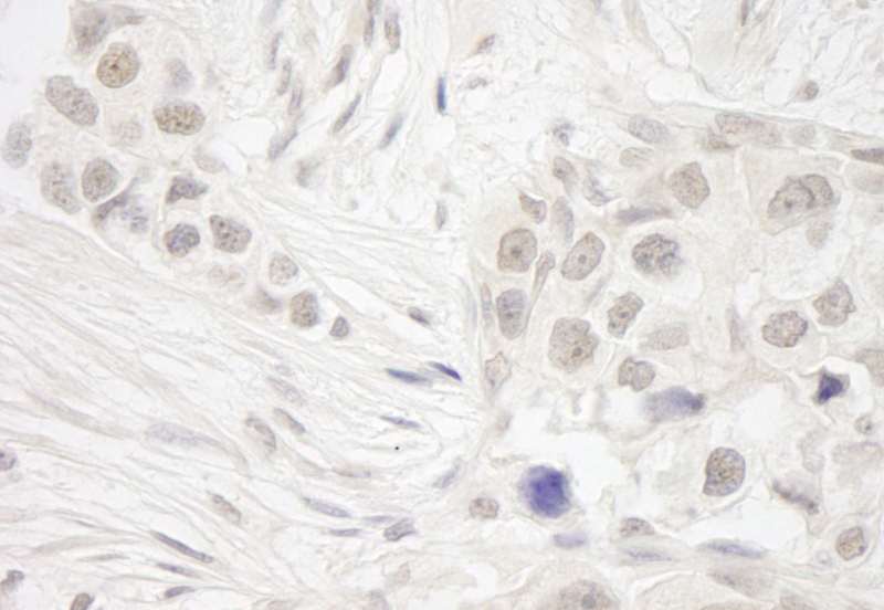 Detection of Human DC8 by Immunohistochemistry. Sample: FFPE section of human breast carcinoma. Antibody: Affinity purified rabbit anti-DC8 used at a dilution of 1:250. Epitope Retrieval Buffer-High pH (IHC-101J) was substituted for Epitope Retrieval Buffer-Reduced pH.