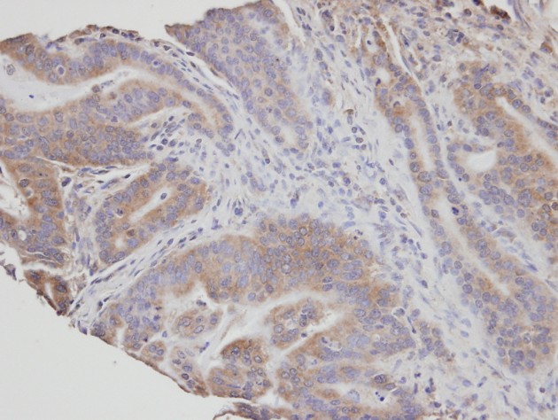 IHC of paraffin-embedded T (gastric CA) using NSMAF antibody at 1:100 dilution.
