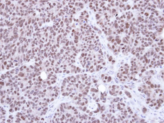 IHC of paraffin-embedded SW480 xenograft using NSMCE1 antibody at 1:500 dilution.