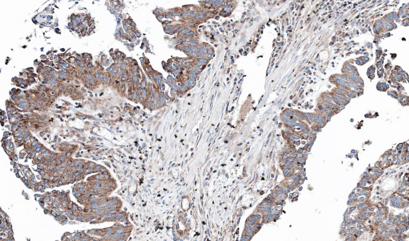 IHC of paraffin-embedded OVCA using NT5C2 antibody at 1:100 dilution.