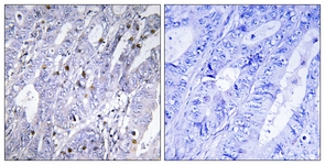 IHC of paraffin-embedded human colon carcinoma tissue, using MEF2D Antibody. The sample on the right was incubated with synthetic peptide.