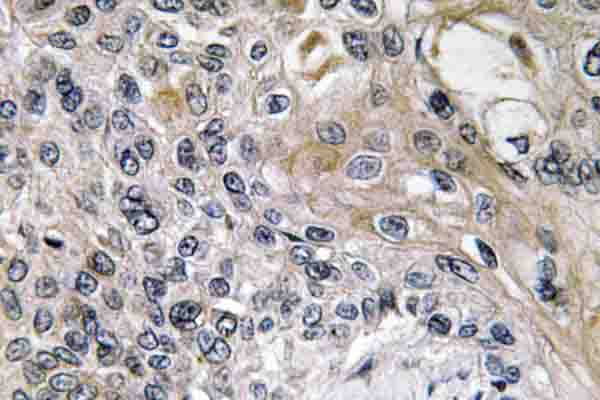 IHC of Netrin-1 (Q533) pAb in paraffin-embedded human lung carcinoma tissue.