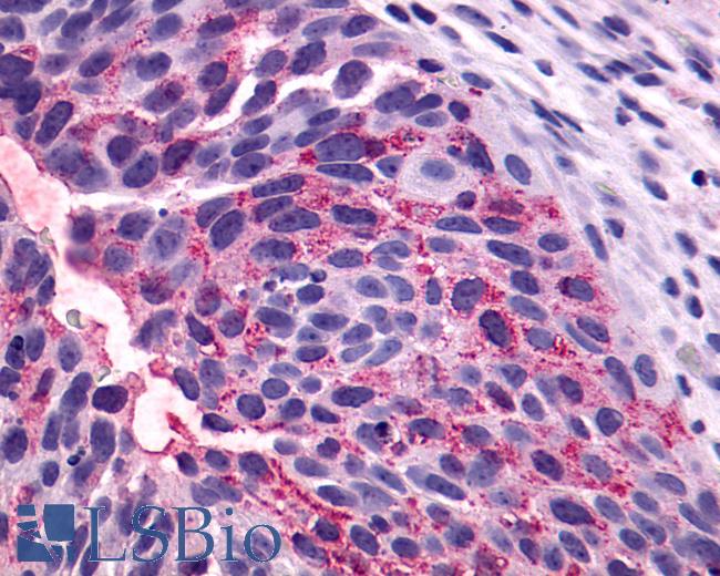 Anti-NTSR1 / NTR antibody IHC of human Bladder, Carcinoma. Immunohistochemistry of formalin-fixed, paraffin-embedded tissue after heat-induced antigen retrieval.