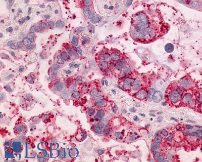 Anti-NTSR1 / NTR antibody IHC of human Lung, Adenocarcinoma. Immunohistochemistry of formalin-fixed, paraffin-embedded tissue after heat-induced antigen retrieval.