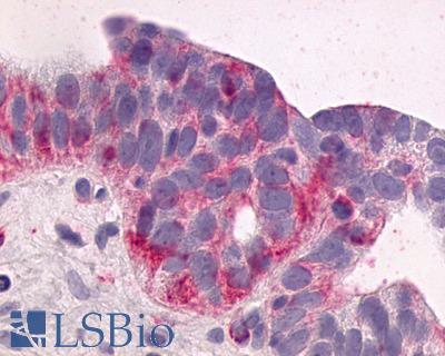 Anti-NTSR1 / NTR antibody IHC of human Ovary, Carcinoma. Immunohistochemistry of formalin-fixed, paraffin-embedded tissue after heat-induced antigen retrieval.