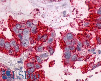 Anti-NTSR1 / NTR antibody IHC of human Lung, Adenocarcinoma. Immunohistochemistry of formalin-fixed, paraffin-embedded tissue after heat-induced antigen retrieval.