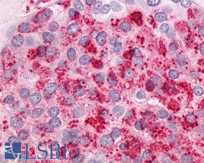 Anti-NTSR1 / NTR antibody IHC of human Ovary, Carcinoma. Immunohistochemistry of formalin-fixed, paraffin-embedded tissue after heat-induced antigen retrieval.