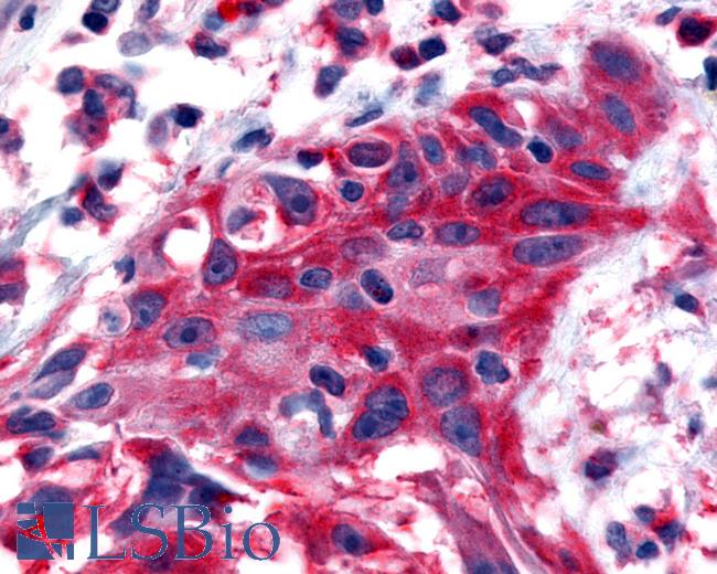 Anti-NTSR2 / NTR2 antibody IHC of human Skin, Melanoma. Immunohistochemistry of formalin-fixed, paraffin-embedded tissue after heat-induced antigen retrieval.